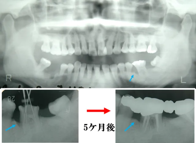水色の矢印に注目。矯正治療をせずに歯周病治療だけで隙間が無くなりました。