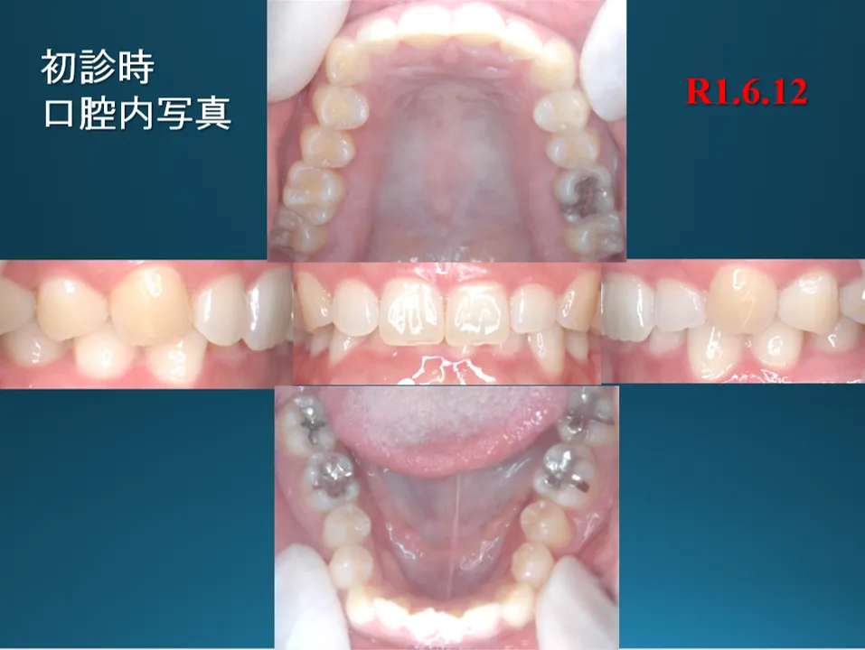 before